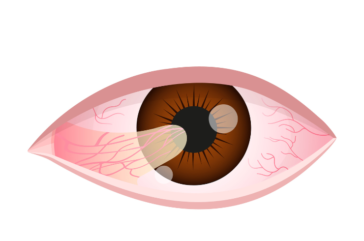 Pterygium Surgery