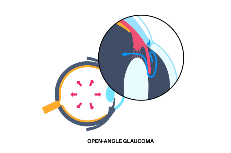 Open angle glaucoma