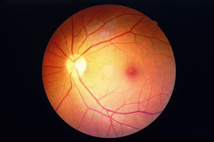 Diabetic retinopathy