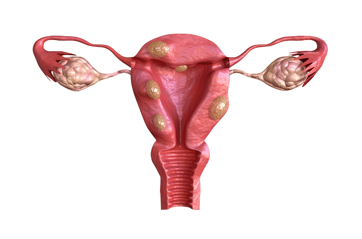 fibroids