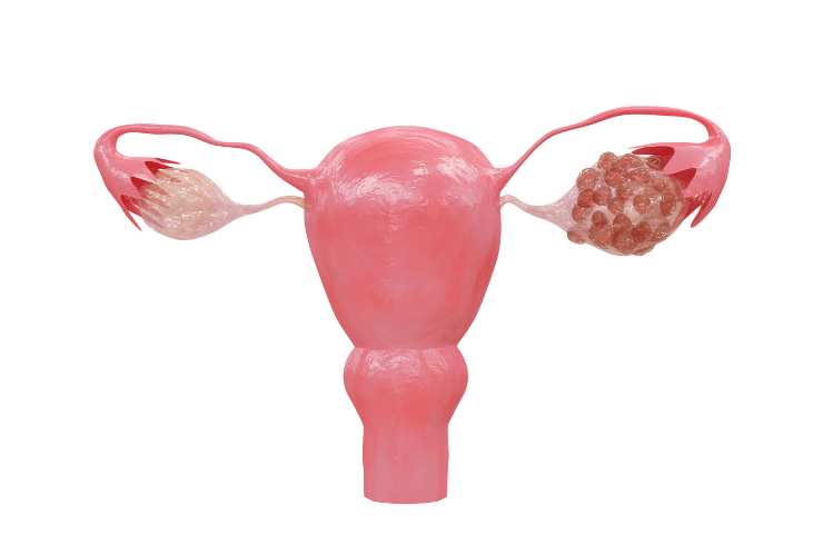 pcos